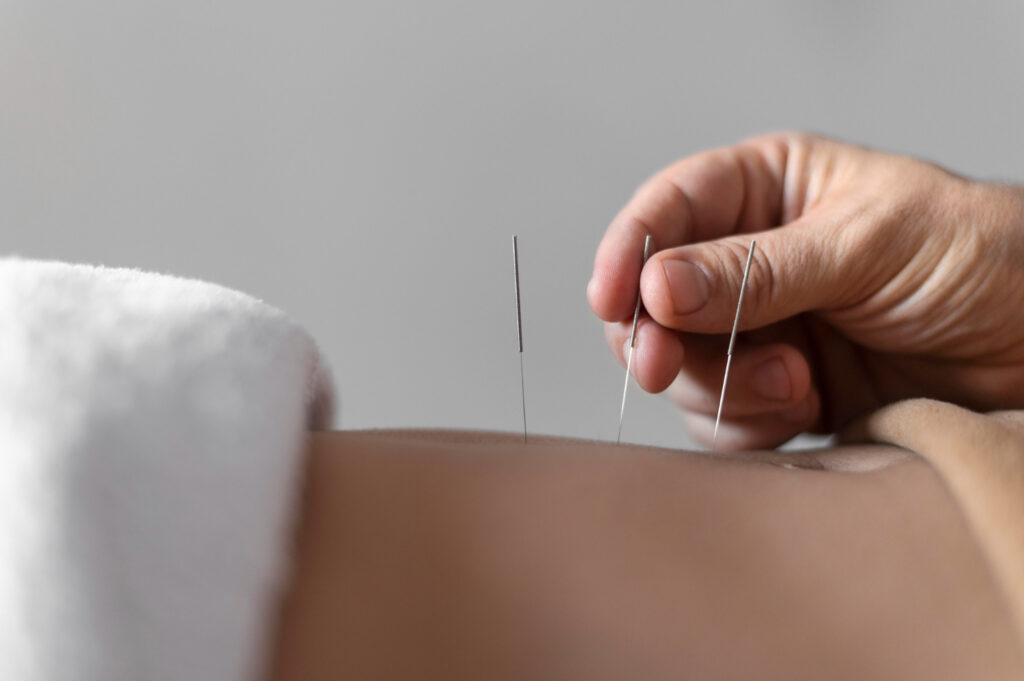 Remboursement Acupuncture