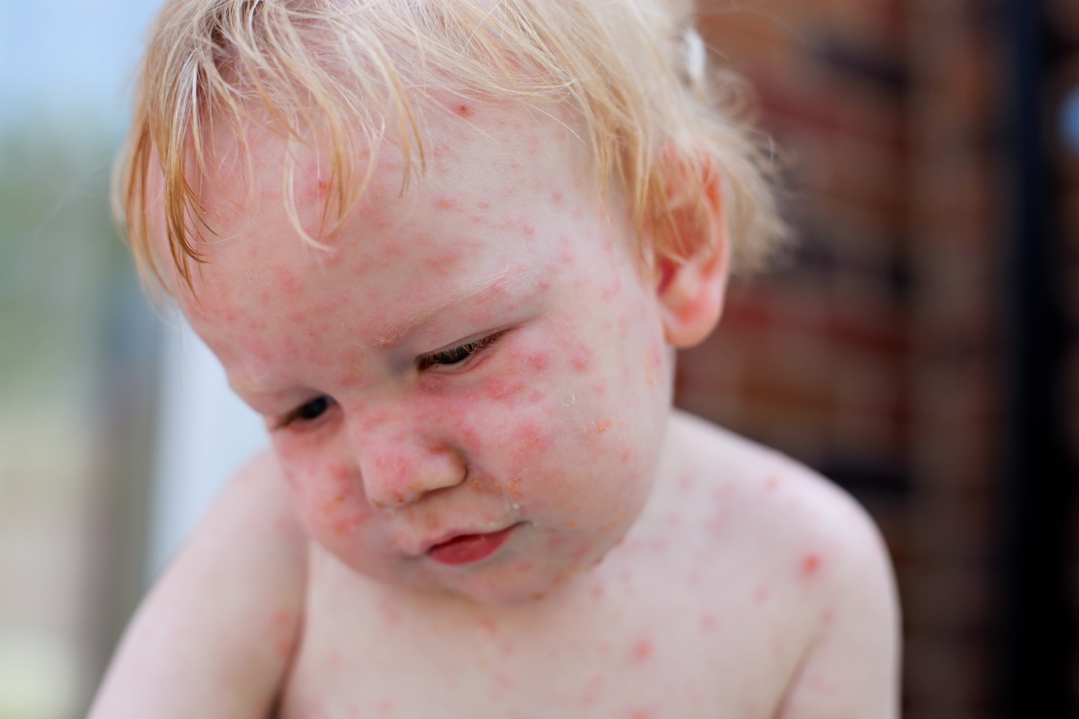 La rougeole : un défi sanitaire mondial malgré les avancées vaccinales